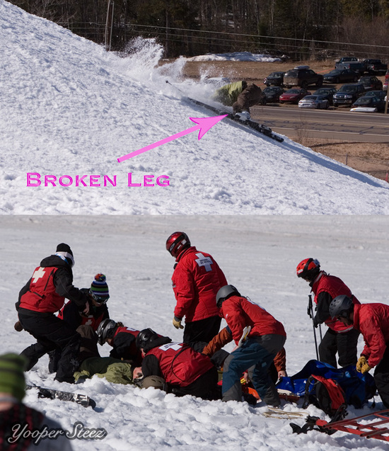Broken Leg